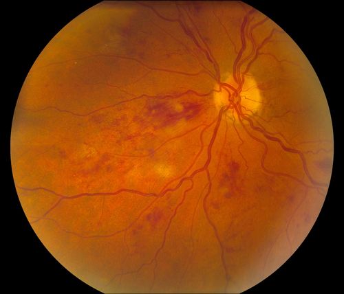 BRVO Inferiorly with Retinal Hemorrhages in the Left Eye
Patient comes in with complaint of "spot in vision", sort of a cloudy haze in the left eye. Patient's VA was 20/100-1 with no improvement with pinhole in the left eye. Fundus photos show multiple retinal hemorrhages scattered with a branch retinal vein occlusion inferiorily. Patient is also diabetic.

