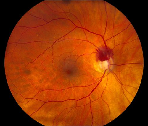 Superior Peripapillary Hemorrhage
Patient was seen for acute vision loss in the right eye. Patient has glaucoma. VA was 20/70 in the right eye. Had Vitrectomy back in May 2012 for ERM stripping. Also had Trabectome with cataract surgery back in December of 2012. Fundus photos presents a Superior Peripapillary Hemorrhage of the optic nerve. Patient will be followed up in one month. 
