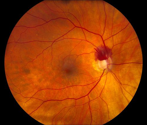 Superior Peripapillary Hemorrhage
Patient was seen for acute vision loss in the right eye. Patient has glaucoma. VA was 20/70 in the right eye. Had Vitrectomy back in May 2012 for ERM stripping. Also had Trabectome with cataract surgery back in December of 2012. Fundus photos presents a Superior Peripapillary Hemorrhage of the optic nerve. Patient will be followed up in one month. 
