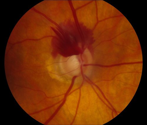 Superior Peripapillary Hemorrhage
Patient was seen for acute vision loss in the right eye. Patient has glaucoma. VA was 20/70 in the right eye. Had Vitrectomy back in May 2012 for ERM stripping. Also had Trabectome with cataract surgery back in December of 2012. Fundus photos presents a Superior Peripapillary Hemorrhage of the optic nerve. Patient will be followed up in one month. 
