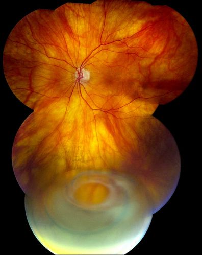 Total Dislocation of Intra Ocular Lens into the Vitreous
84-year old female comes in with blurred vision in the left eye. VA was 20/30, right eye and Count Fingers in the left eye. Fundus examination reveals dislocation of the IOL into the vitreous inferiorily @ 6-o'clock. Suggest surgery to fix the problem.  
