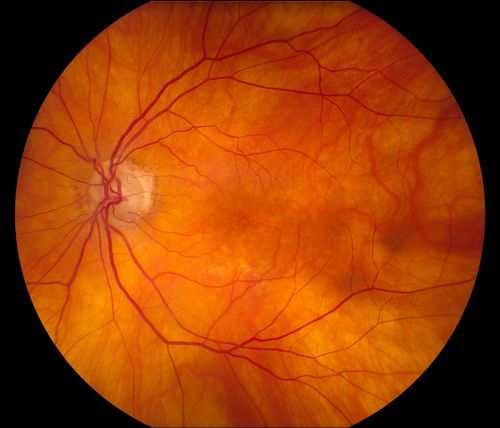 Total Dislocation of Intra Ocular Lens into the Vitreous
84-year old female comes in with blurred vision in the left eye. VA was 20/30, right eye and Count Fingers in the left eye. Fundus examination reveals dislocation of the IOL into the vitreous inferiorily @ 6-o'clock. Suggest surgery to fix the problem.  
