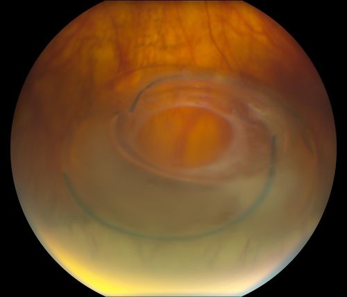 Total Dislocation of Intra Ocular Lens into the Vitreous
84-year old female comes in with blurred vision in the left eye. VA was 20/30, right eye and Count Fingers in the left eye. Fundus examination reveals dislocation of the IOL into the vitreous inferiorily @ 6-o'clock. Suggest surgery to fix the problem.  

