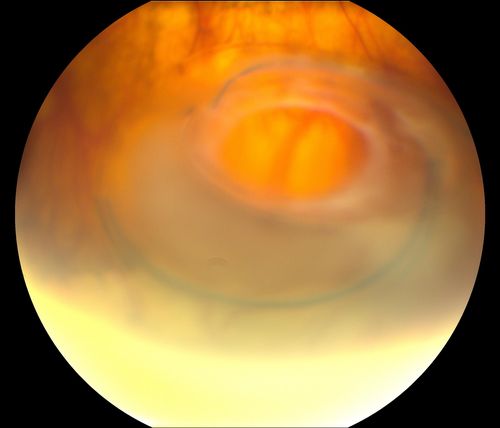 Total Dislocation of Intra Ocular Lens into the Vitreous
84-year old female comes in with blurred vision in the left eye. VA was 20/30, right eye and Count Fingers in the left eye. Fundus examination reveals dislocation of the IOL into the vitreous inferiorily @ 6-o'clock. Suggest surgery to fix the problem.  
