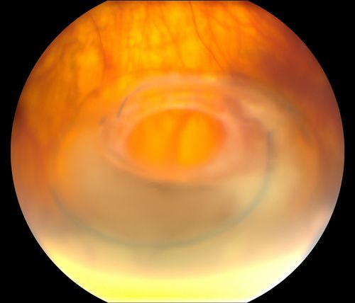 Total Dislocation of Intra Ocular Lens into the Vitreous
84-year old female comes in with blurred vision in the left eye. VA was 20/30, right eye and Count Fingers in the left eye. Fundus examination reveals dislocation of the IOL into the vitreous inferiorily @ 6-o'clock. Suggest surgery to fix the problem.  
