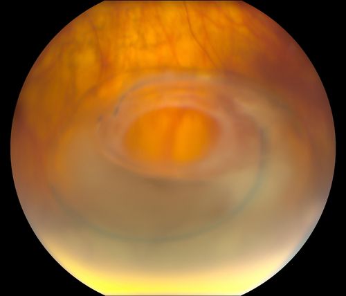 Total Dislocation of Intra Ocular Lens into the Vitreous
84-year old female comes in with blurred vision in the left eye. VA was 20/30, right eye and Count Fingers in the left eye. Fundus examination reveals dislocation of the IOL into the vitreous inferiorily @ 6-o'clock. Suggest surgery to fix the problem.  
