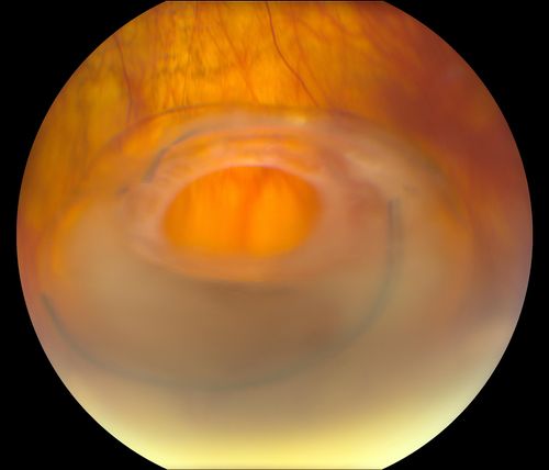 Total Dislocation of Intra Ocular Lens into the Vitreous
84-year old female comes in with blurred vision in the left eye. VA was 20/30, right eye and Count Fingers in the left eye. Fundus examination reveals dislocation of the IOL into the vitreous inferiorily @ 6-o'clock. Suggest surgery to fix the problem.  
