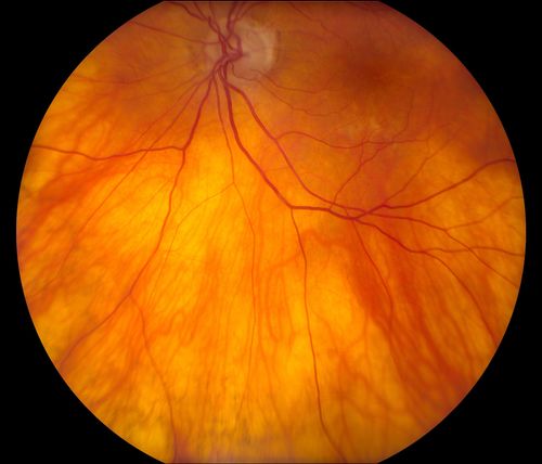 Total Dislocation of Intra Ocular Lens into the Vitreous
84-year old female comes in with blurred vision in the left eye. VA was 20/30, right eye and Count Fingers in the left eye. Fundus examination reveals dislocation of the IOL into the vitreous inferiorily @ 6-o'clock. Suggest surgery to fix the problem.  
