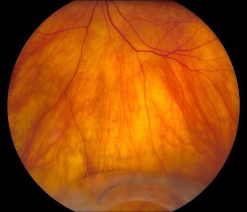 Total Dislocation of Intra Ocular Lens into the Vitreous
84-year old female comes in with blurred vision in the left eye. VA was 20/30, right eye and Count Fingers in the left eye. Fundus examination reveals dislocation of the IOL into the vitreous inferiorily @ 6-o'clock. Suggest surgery to fix the problem.  
