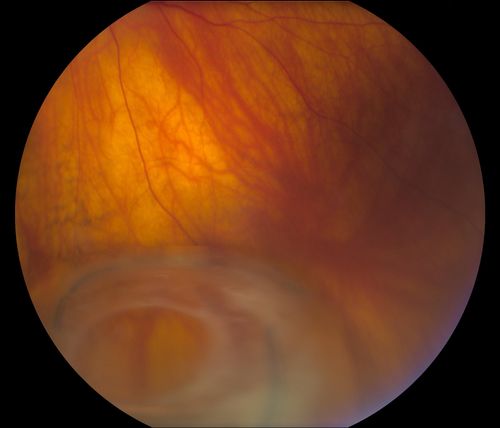 Total Dislocation of Intra Ocular Lens into the Vitreous
84-year old female comes in with blurred vision in the left eye. VA was 20/30, right eye and Count Fingers in the left eye. Fundus examination reveals dislocation of the IOL into the vitreous inferiorily @ 6-o'clock. Suggest surgery to fix the problem.  
