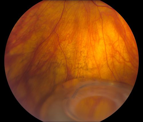 Total Dislocation of Intra Ocular Lens into the Vitreous
84-year old female comes in with blurred vision in the left eye. VA was 20/30, right eye and Count Fingers in the left eye. Fundus examination reveals dislocation of the IOL into the vitreous inferiorily @ 6-o'clock. Suggest surgery to fix the problem.  
