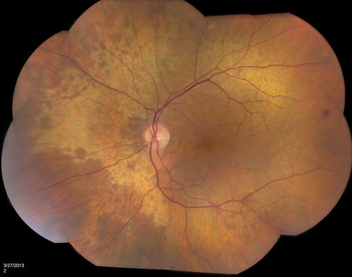 Peripheral Retinal Degeneration
Patient comes in with double vision. VA was 20/20 in both eyes. Fundus exam shows Retinal Degenerative changes in both eyes. Offer to correct double vision with temporary Fresnel prism
