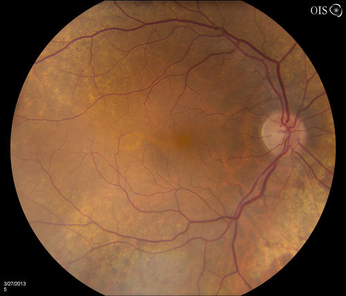Peripheral Retinal Degeneration
Patient comes in with double vision. VA was 20/20 in both eyes. Fundus exam shows Retinal Degenerative changes in both eyes. Offer to correct double vision with temporary Fresnel prism
