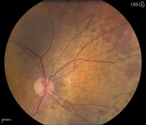 Peripheral Retinal Degeneration
Patient comes in with double vision. VA was 20/20 in both eyes. Fundus exam shows Retinal Degenerative changes in both eyes. Offer to correct double vision with temporary Fresnel prism

