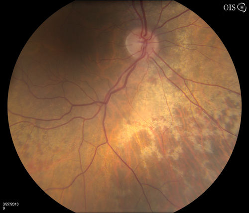 Peripheral Retinal Degeneration
Patient comes in with double vision. VA was 20/20 in both eyes. Fundus exam shows Retinal Degenerative changes in both eyes. Offer to correct double vision with temporary Fresnel prism
