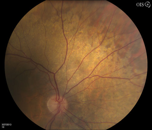 Peripheral Retinal Degeneration
Patient comes in with double vision. VA was 20/20 in both eyes. Fundus exam shows Retinal Degenerative changes in both eyes. Offer to correct double vision with temporary Fresnel prism
