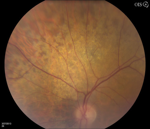 Peripheral Retinal Degeneration
Patient comes in with double vision. VA was 20/20 in both eyes. Fundus exam shows Retinal Degenerative changes in both eyes. Offer to correct double vision with temporary Fresnel prism
