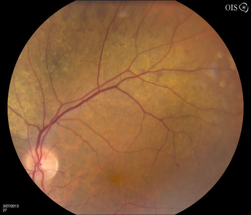 Peripheral Retinal Degeneration
Patient comes in with double vision. VA was 20/20 in both eyes. Fundus exam shows Retinal Degenerative changes in both eyes. Offer to correct double vision with temporary Fresnel prism
