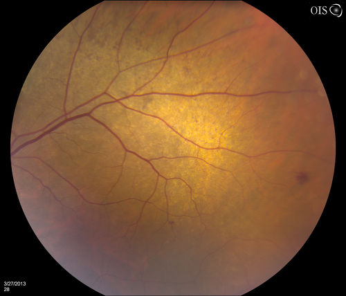 Peripheral Retinal Degeneration
Patient comes in with double vision. VA was 20/20 in both eyes. Fundus exam shows Retinal Degenerative changes in both eyes. Offer to correct double vision with temporary Fresnel prism
