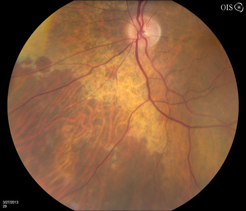 Peripheral Retinal Degeneration
Patient comes in with double vision. VA was 20/20 in both eyes. Fundus exam shows Retinal Degenerative changes in both eyes. Offer to correct double vision with temporary Fresnel prism
