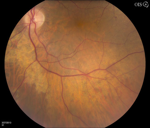 Peripheral Retinal Degeneration
Patient comes in with double vision. VA was 20/20 in both eyes. Fundus exam shows Retinal Degenerative changes in both eyes. Offer to correct double vision with temporary Fresnel prism
