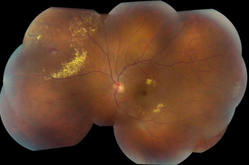 38-year old male presents with decreased vision in the left eye. VA was 20/20-right eye and 20/70-left eye with pinhole no improvement. Fundus exam shows exudates near the macula and also exudates with small hemorrhages, superior nasally in the left eye. 
