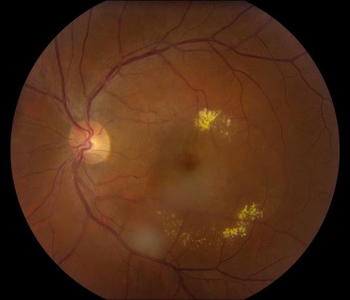 38-year old male presents with decreased vision in the left eye. VA was 20/20-right eye and 20/70-left eye with pinhole no improvement. Fundus exam shows exudates near the macula and also exudates with small hemorrhages, superior nasally in the left eye. 
