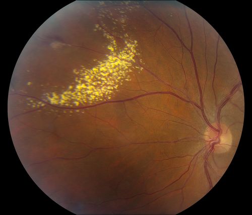 38-year old male presents with decreased vision in the left eye. VA was 20/20-right eye and 20/70-left eye with pinhole no improvement. Fundus exam shows exudates near the macula and also exudates with small hemorrhages, superior nasally in the left eye. 
