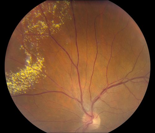 38-year old male presents with decreased vision in the left eye. VA was 20/20-right eye and 20/70-left eye with pinhole no improvement. Fundus exam shows exudates near the macula and also exudates with small hemorrhages, superior nasally in the left eye. 
