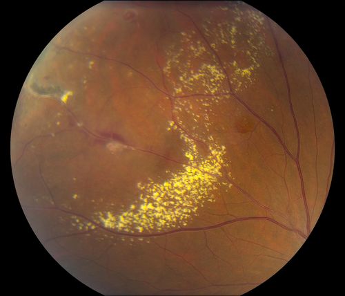 38-year old male presents with decreased vision in the left eye. VA was 20/20-right eye and 20/70-left eye with pinhole no improvement. Fundus exam shows exudates near the macula and also exudates with small hemorrhages, superior nasally in the left eye. 
