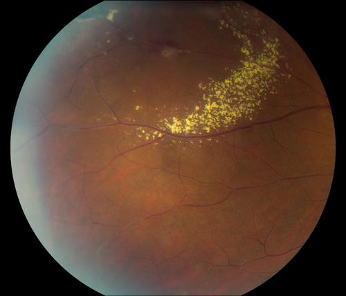 38-year old male presents with decreased vision in the left eye. VA was 20/20-right eye and 20/70-left eye with pinhole no improvement. Fundus exam shows exudates near the macula and also exudates with small hemorrhages, superior nasally in the left eye. 
