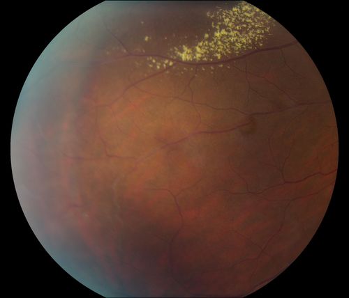 38-year old male presents with decreased vision in the left eye. VA was 20/20-right eye and 20/70-left eye with pinhole no improvement. Fundus exam shows exudates near the macula and also exudates with small hemorrhages, superior nasally in the left eye. 
