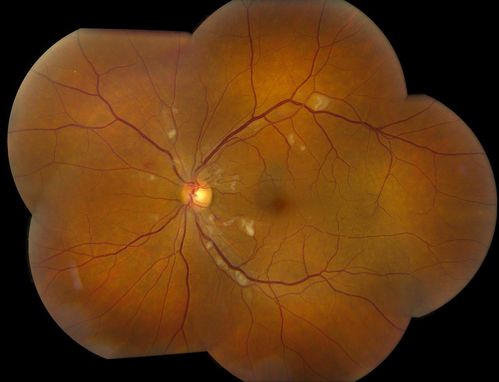 Hypertensive Retinopathy
Patient comes in complaining of spots in vision in both eyes. VA was 20/25 - right eye and 20/20- left eye. Fundus exam reveals little hemorrhages with cotton wool spots due to hypertension and anemia. 
