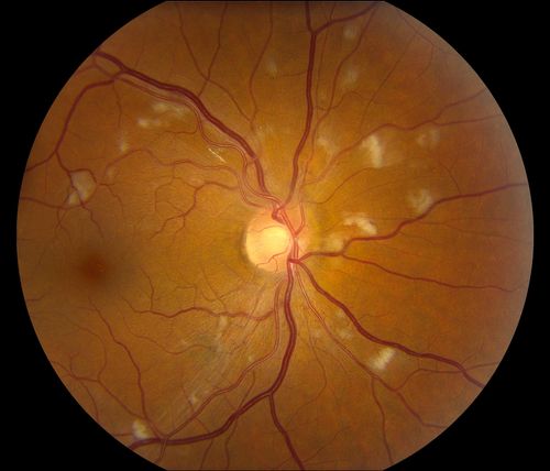 Hypertensive Retinopathy
Patient comes in complaining of spots in vision in both eyes. VA was 20/25 - right eye and 20/20- left eye. Fundus exam reveals little hemorrhages with cotton wool spots due to hypertension and anemia. 
