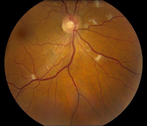 Hypertensive Retinopathy
Patient comes in complaining of spots in vision in both eyes. VA was 20/25 - right eye and 20/20- left eye. Fundus exam reveals little hemorrhages with cotton wool spots due to hypertension and anemia. 
