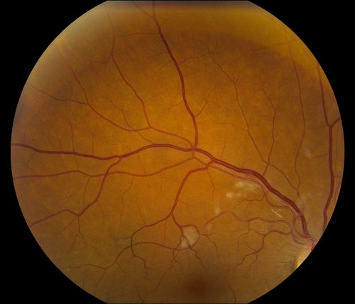 Hypertensive Retinopathy
Patient comes in complaining of spots in vision in both eyes. VA was 20/25 - right eye and 20/20- left eye. Fundus exam reveals little hemorrhages with cotton wool spots due to hypertension and anemia. 

