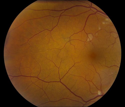 Hypertensive Retinopathy
Patient comes in complaining of spots in vision in both eyes. VA was 20/25 - right eye and 20/20- left eye. Fundus exam reveals little hemorrhages with cotton wool spots due to hypertension and anemia. 
