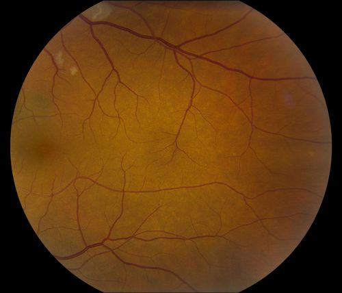 Hypertensive Retinopathy
Patient comes in complaining of spots in vision in both eyes. VA was 20/25 - right eye and 20/20- left eye. Fundus exam reveals little hemorrhages with cotton wool spots due to hypertension and anemia.  
