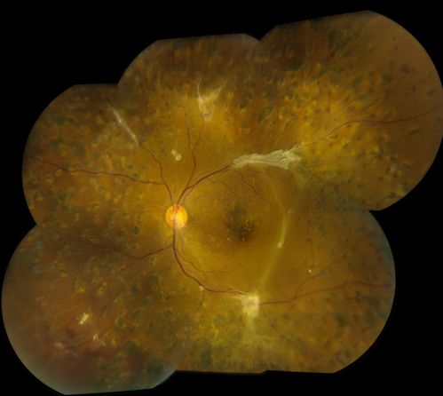 Post-Op Vitrectomy with Membrane Stripping and Laser
Patient had surgery to help clear up some vision in the left eye. Pre-op VA was count fingers at 1-ft. Post op VA was 20/200 in the left eye. Patient will return in 3-months for follow-up.
