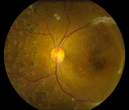 Post-Op Vitrectomy with Membrane Stripping and Laser
Patient had surgery to help clear up some vision in the left eye. Pre-op VA was count fingers at 1-ft. Post op VA was 20/200 in the left eye. Patient will return in 3-months for follow-up.
