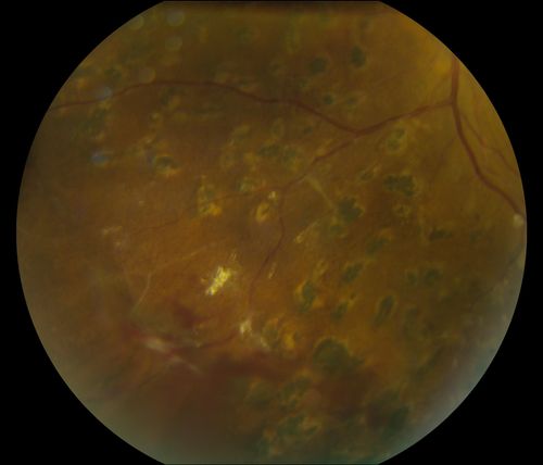 Post-Op Vitrectomy with Membrane Stripping and Laser
Patient had surgery to help clear up some vision in the left eye. Pre-op VA was count fingers at 1-ft. Post op VA was 20/200 in the left eye. Patient will return in 3-months for follow-up.
