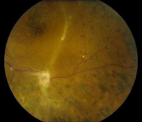 Post-Op Vitrectomy with Membrane Stripping and Laser
Patient had surgery to help clear up some vision in the left eye. Pre-op VA was count fingers at 1-ft. Post op VA was 20/200 in the left eye. Patient will return in 3-months for follow-up.
