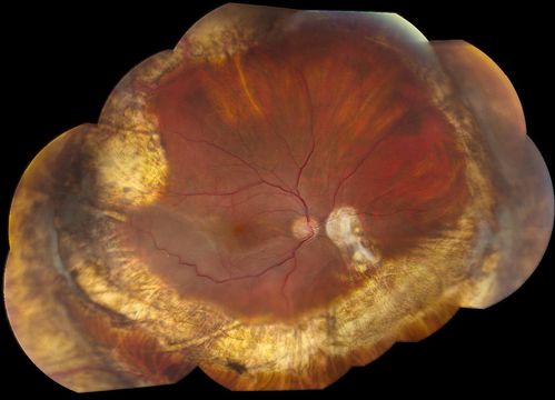 Reoccurring Retinal Detachment
Patient comes in for second opinion for RD in the right eye. Patient's VA was count fingers @ 2-ft in the right eye and 20/20 in the left eye. Patient is aphakic and has had 5- retinal surgeries in the past in the right eye including a scleral buckle. RD present with the macula off. Will consider surgery with silicone oil. 
Keywords: may2013