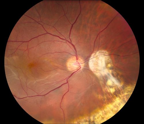 Reoccurring Retinal Detachment
Patient comes in for second opinion for RD in the right eye. Patient's VA was count fingers @ 2-ft in the right eye and 20/20 in the left eye. Patient is aphakic and has had 5- retinal surgeries in the past in the right eye including a scleral buckle. RD present with the macula off. Will consider surgery with silicone oil. 
