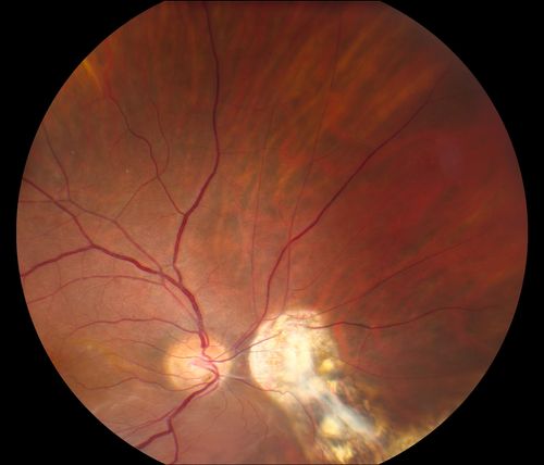 Reoccurring Retinal Detachment
Patient comes in for second opinion for RD in the right eye. Patient's VA was count fingers @ 2-ft in the right eye and 20/20 in the left eye. Patient is aphakic and has had 5- retinal surgeries in the past in the right eye including a scleral buckle. RD present with the macula off. Will consider surgery with silicone oil. 

