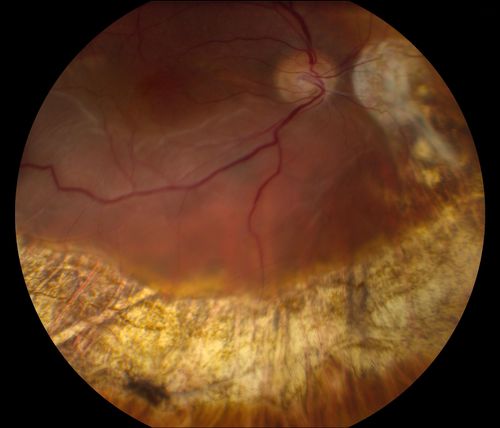 Reoccurring Retinal Detachment
Patient comes in for second opinion for RD in the right eye. Patient's VA was count fingers @ 2-ft in the right eye and 20/20 in the left eye. Patient is aphakic and has had 5- retinal surgeries in the past in the right eye including a scleral buckle. RD present with the macula off. Will consider surgery with silicone oil. 
