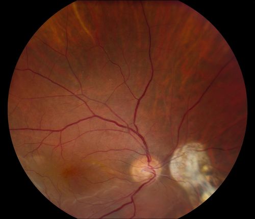 Reoccurring Retinal Detachment
Patient comes in for second opinion for RD in the right eye. Patient's VA was count fingers @ 2-ft in the right eye and 20/20 in the left eye. Patient is aphakic and has had 5- retinal surgeries in the past in the right eye including a scleral buckle. RD present with the macula off. Will consider surgery with silicone oil. 
