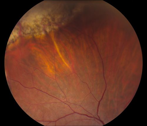 Reoccurring Retinal Detachment
Patient comes in for second opinion for RD in the right eye. Patient's VA was count fingers @ 2-ft in the right eye and 20/20 in the left eye. Patient is aphakic and has had 5- retinal surgeries in the past in the right eye including a scleral buckle. RD present with the macula off. Will consider surgery with silicone oil. 
