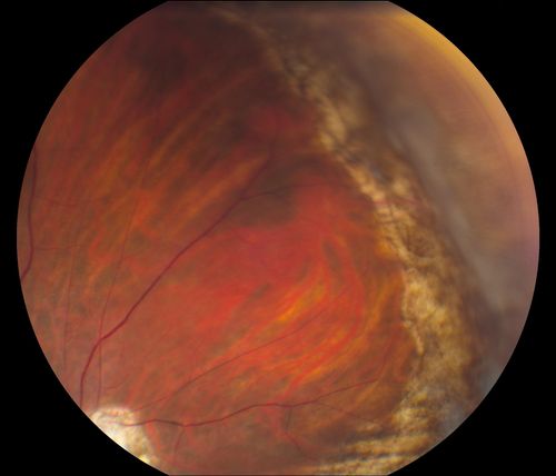 Reoccurring Retinal Detachment
Patient comes in for second opinion for RD in the right eye. Patient's VA was count fingers @ 2-ft in the right eye and 20/20 in the left eye. Patient is aphakic and has had 5- retinal surgeries in the past in the right eye including a scleral buckle. RD present with the macula off. Will consider surgery with silicone oil. 
