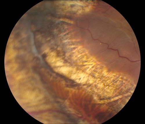 Reoccurring Retinal Detachment
Patient comes in for second opinion for RD in the right eye. Patient's VA was count fingers @ 2-ft in the right eye and 20/20 in the left eye. Patient is aphakic and has had 5- retinal surgeries in the past in the right eye including a scleral buckle. RD present with the macula off. Will consider surgery with silicone oil. 
